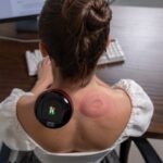 Cupping TrendRehab
